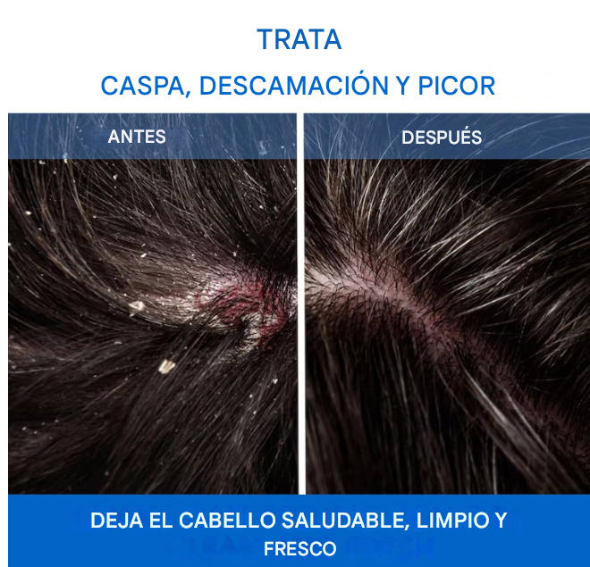 🫧SHAMPOO NIPPORI MEDICO -Adiós Caspa, Mal Olor y Picazón en 3 Aplicaciones
