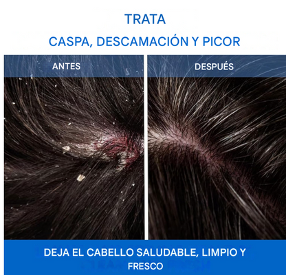 🫧SHAMPOO NIPPORI MEDICO -Adiós Caspa, Mal Olor y Picazón en 3 Aplicaciones